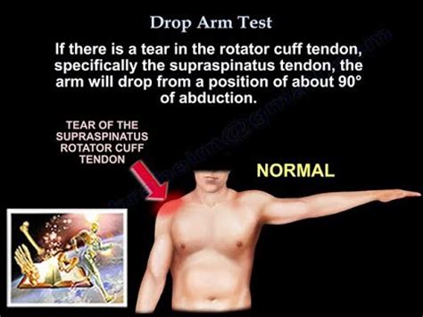 the drop shoulder test|how do i know if need rotator cuff surgery.